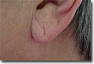 ear_lobe_repair_01_before_web
