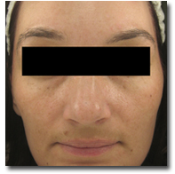 chemical_peel_before and after 01