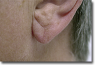 ear_lobe_repair_01_after_web