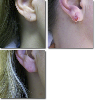 ear_lobe_repair_02_web-1