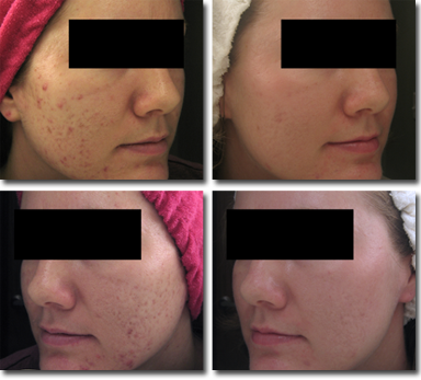 microdermabrasion before and after