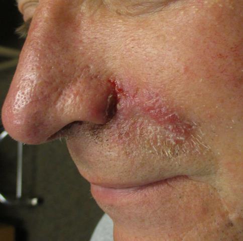 MOHS Surgery Photos | Before & After | ADC Derm