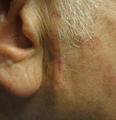 MOHS Surgery Photos | Before & After | ADC Derm