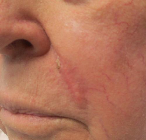 MOHS Surgery Photos | Before & After | ADC Derm