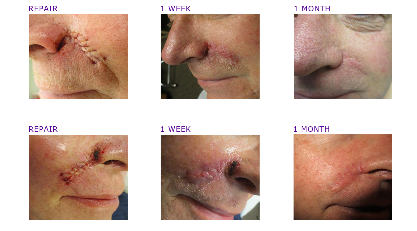 MOHSGRIDCHEEK1 Advanced Dermatology Care