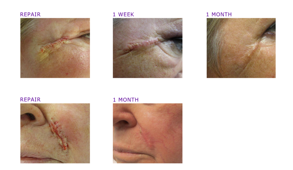 MOHS Surgery Photos Before & After ADC Derm