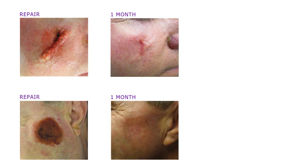 Mohs Surgery Photos Before And After Adc Derm 