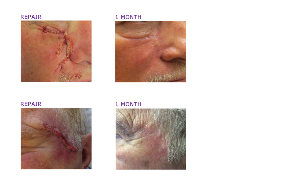 MOHS Surgery Photos Before & After ADC Derm