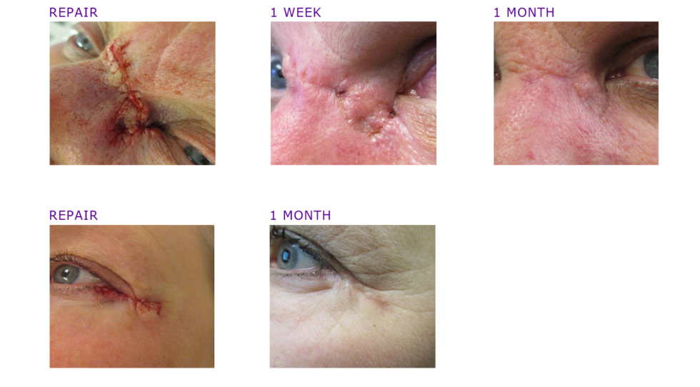 mohs-surgery-photos-before-after-adc-derm