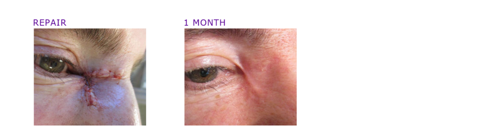 MOHS Surgery Photos | Before & After | ADC Derm