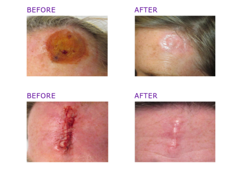 MOHS Surgery Photos | Before & After | ADC Derm