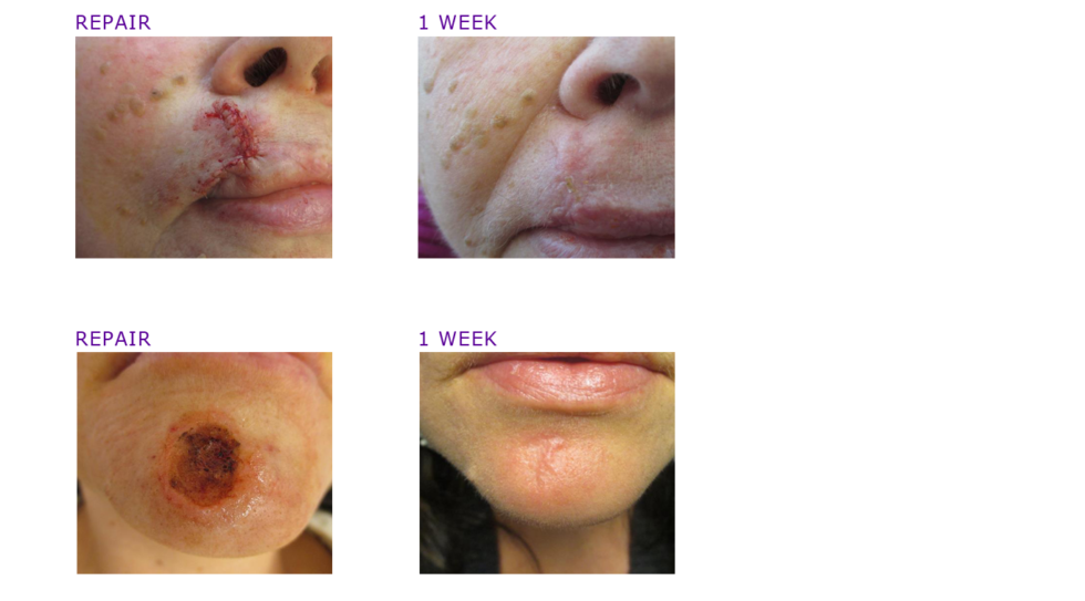 Mohs Surgery Photos Before And After Adc Derm